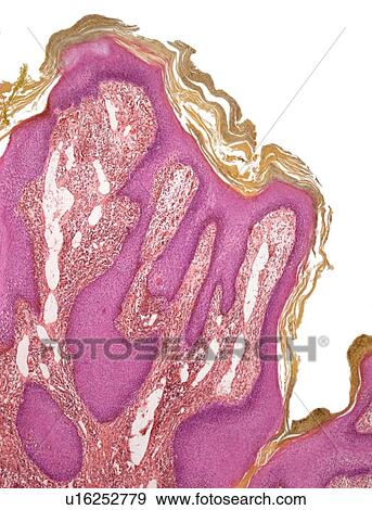 Wart, light micrograph View Large Photo Image Stock Photo - Wart, light micrograph. Fotosearch