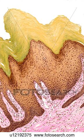 Stock Photography - Wart, light micrograph. Fotosearch