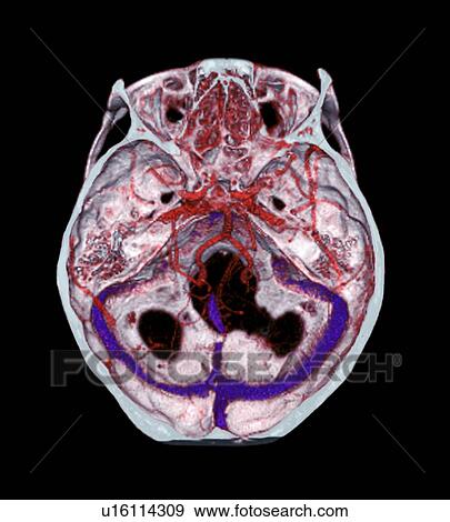 動脈 の 脳 ３ｄ Ct 走査 写真館 イメージ館 U Fotosearch