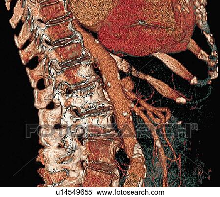 Stock Photography - Abdominal aorta and spine, 3D CT scan. Fotosearch