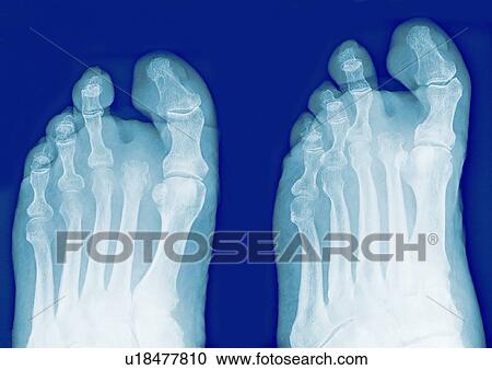 Stock Image - Amputated toe, X-rays. Fotosearch
