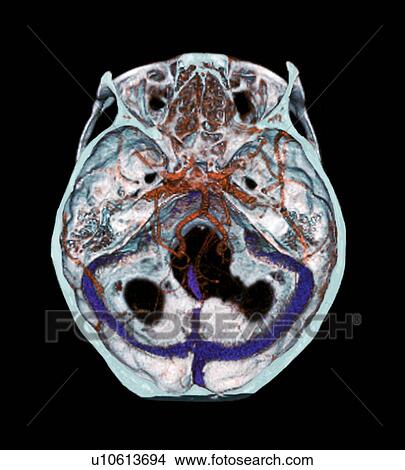 Picture - Arteries of the brain, 3D CT scan. Fotosearch