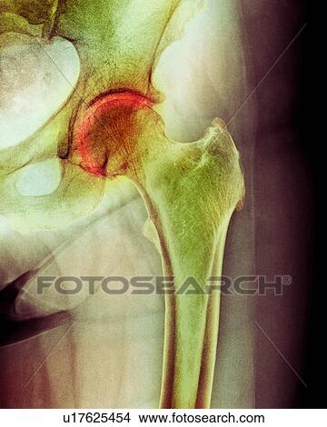 Picture - Arthritis of the hip, X-ray. Fotosearch