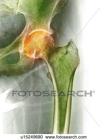 Stock Image - Arthritis of the hip, X-ray. Fotosearch