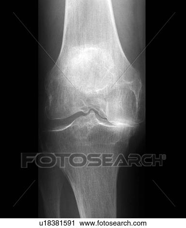 Arthritis of the knee, X-ray View Large Photo Image Stock Image - Arthritis of the knee, X-ray. Fotosearch