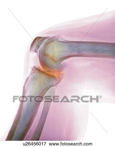 Arthritis of the knee, X-ray View Large Photo Image Stock Photo - Arthritis of the knee, X-ray. Fotosearch