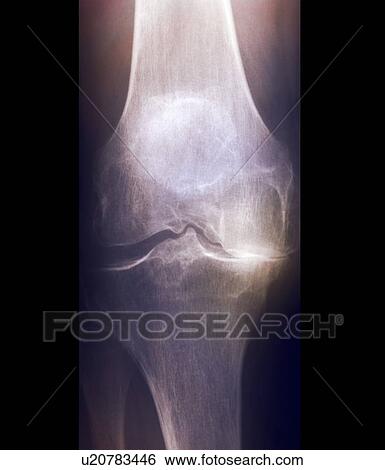 Stock Photograph - Arthritis of the knee, X-ray. Fotosearch
