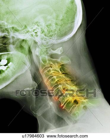 Stock Image - Arthritis of the neck, X-ray. Fotosearch