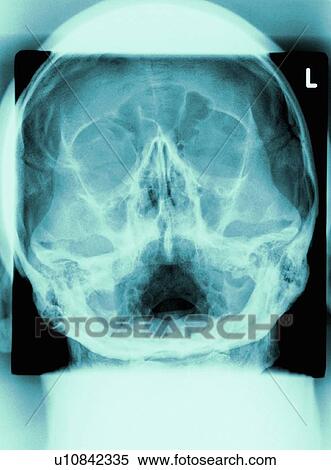 Healthy skull, X-ray View Large Photo Image Stock Photography - Healthy skull, X-ray. Fotosearch
