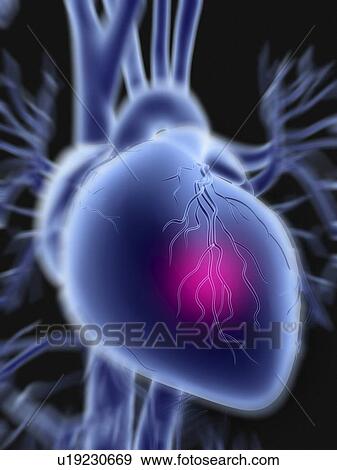 Heart attack View Large Photo Image Stock Photo - Heart attack. Fotosearch