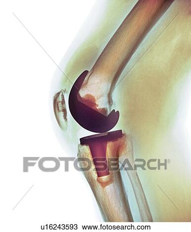 Knee replacement, X-ray View Large Photo Image Stock Image - Knee replacement, X-ray. Fotosearch