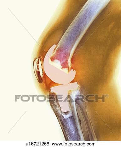 Knee replacement, X-ray View Large Photo Image Stock Photo - Knee replacement, X-ray. Fotosearch