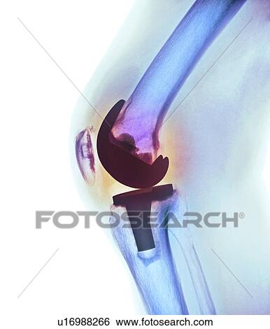 Knee replacement, X-ray View Large Photo Image Stock Photograph - Knee replacement, X-ray. Fotosearch