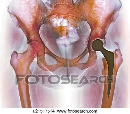 Loosened hip replacement, X-ray View Large Photo Image Picture - Loosened hip replacement, X-ray. Fotosearch