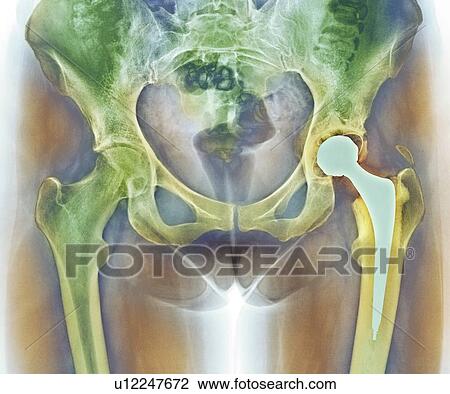 Loosened hip replacement, X-ray View Large Photo Image Stock Image - Loosened hip replacement, X-ray. Fotosearch