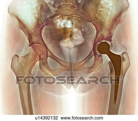 Stock Image - Loosened hip replacement, X-ray. Fotosearch