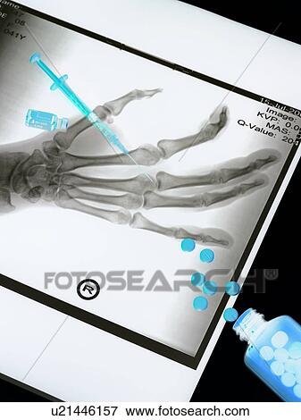 Stock Photo - Medical treatment, conceptual image. Fotosearch