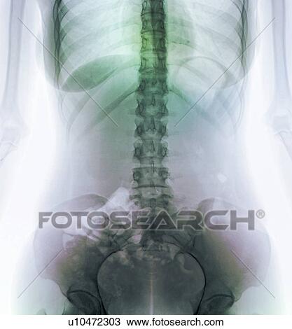 Stock Image - Normal abdomen, X-ray. Fotosearch