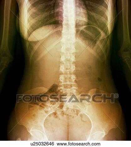 Stock Photograph - Normal abdomen, X-ray. Fotosearch