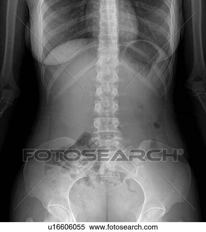 Stock Photography - Normal abdomen, X-ray. Fotosearch