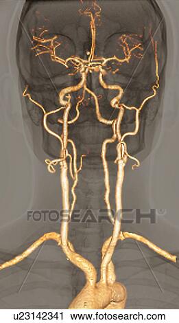 Stock Image - Normal arteries, 3D CT scan. Fotosearch
