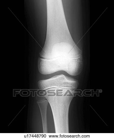 Stock Image - Normal child's knee, X-ray. Fotosearch