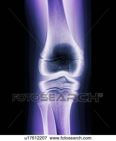 Stock Photo - Normal child's knee, X-ray. Fotosearch