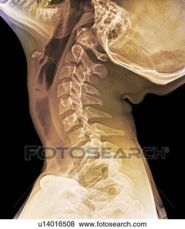 Stock Photo - Normal extended neck, X-ray. Fotosearch