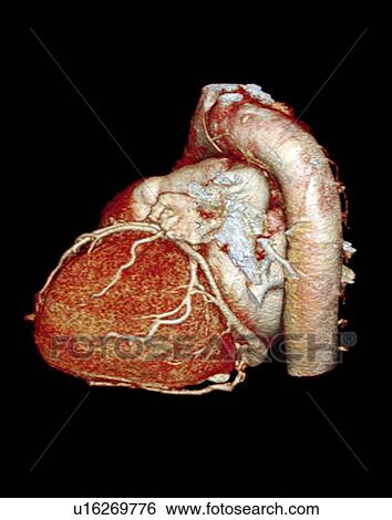 Normal heart, 3D CT scan View Large Photo Image Stock Photograph - Normal heart, 3D CT scan. Fotosearch