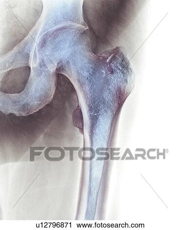 Normal hip, X-ray View Large Photo Image Stock Image - Normal hip, X-ray. Fotosearch