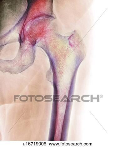 Normal hip, X-ray View Large Photo Image Stock Photograph - Normal hip, X-ray. Fotosearch