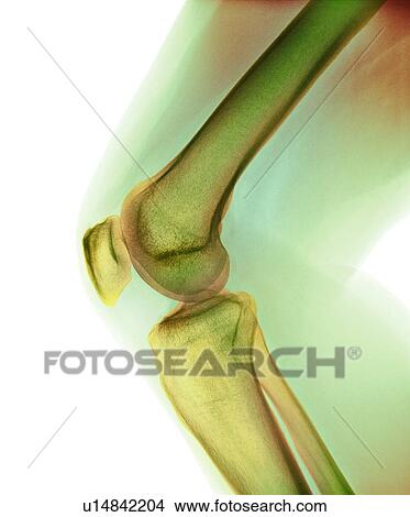 Picture - Normal knee, X-ray. Fotosearch