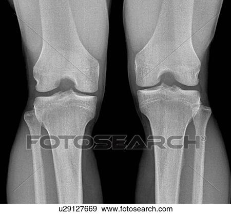 Stock Photo - Normal knees, X-ray. Fotosearch