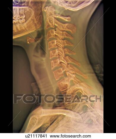 Stock Image - Normal neck, X-ray. Fotosearch