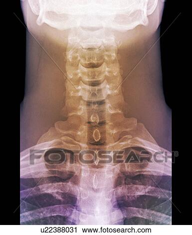 Stock Image - Normal neck, X-ray. Fotosearch