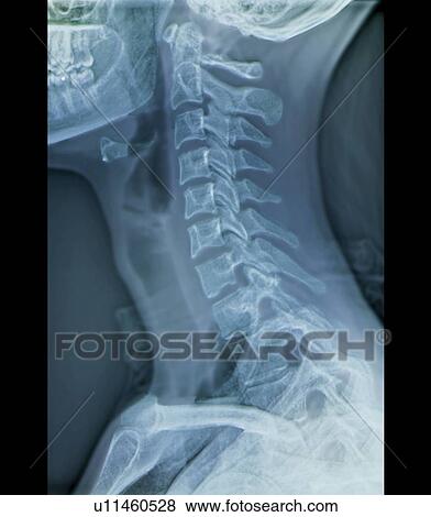 Normal neck, X-ray View Large Photo Image Stock Photo - Normal neck, X-ray. Fotosearch