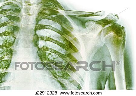 Stock Photo - Normal shoulder, X-ray. Fotosearch