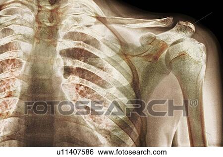 Normal shoulder, X-ray View Large Photo Image Stock Photograph - Normal shoulder, X-ray. Fotosearch