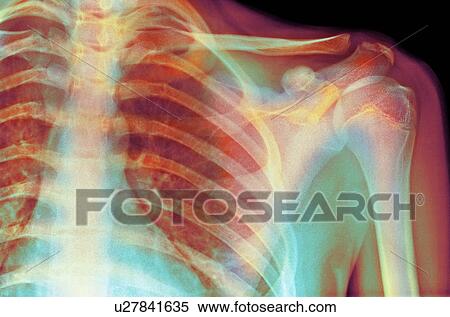 Stock Photography - Normal shoulder, X-ray. Fotosearch