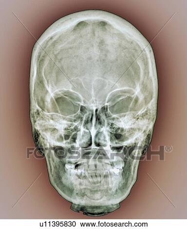 Normal skull, X-ray View Large Photo Image Stock Image - Normal skull, X-ray. Fotosearch