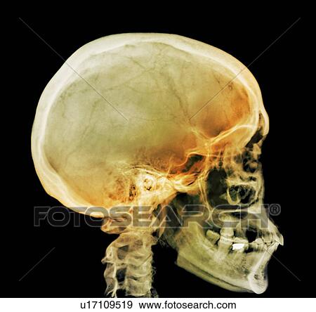 Normal skull, X-ray View Large Photo Image Stock Photo - Normal skull, X-ray. Fotosearch