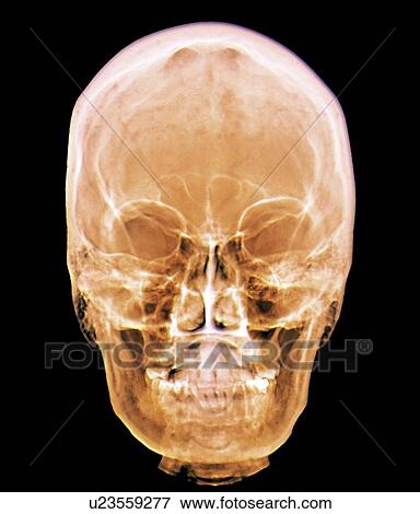 Stock Photo - Normal skull, X-ray. Fotosearch