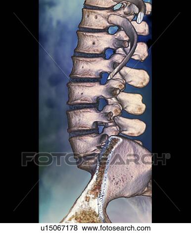 Normal spine, CT scan View Large Photo Image Stock Photo - Normal spine, CT scan. Fotosearch