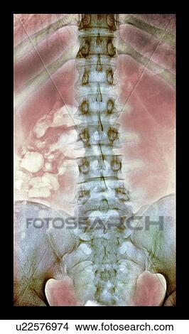Picture - Normal spine, X-ray. Fotosearch