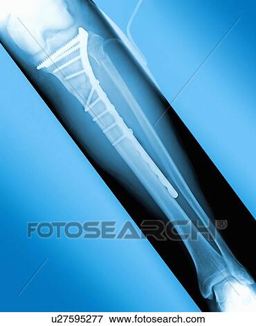 Pinned broken leg, X-ray View Large Photo Image Stock Photo - Pinned broken leg, X-ray. Fotosearch