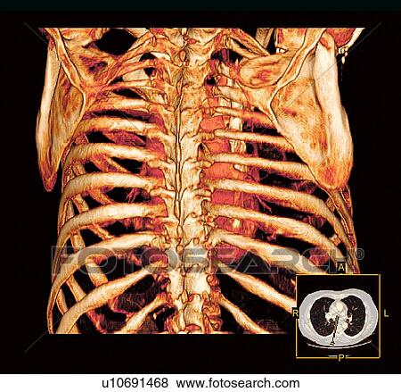 Rib cage and heart, 3D CT scan View Large Photo Image Stock Photo - Rib cage and heart, 3D CT scan. Fotosearch