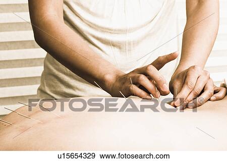 Nurse with acupuncture patient View Large Photo Image Stock Photo - Nurse with acupuncture patient. Fotosearch