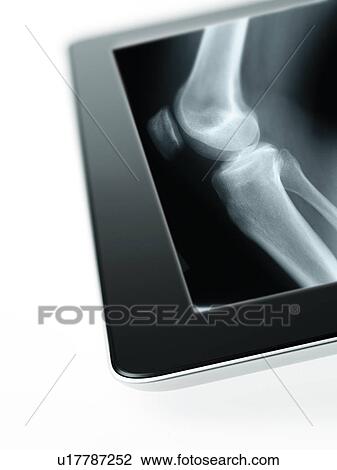 Studio shot of digital tablet with x-ray of human knee View Large Photo Image Stock Image - Studio shot of digital tablet with x-ray of human knee. Fotosearch