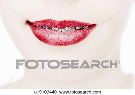 Stock Image - Close up of woman in braces. Fotosearch
