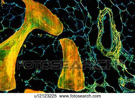 Stock Photography - Bone spicules, marrow and adipose tissue. Fotosearch